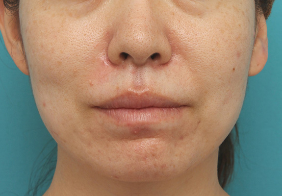 症例写真,分厚い上下の唇を手術で薄くした症例写真,After（6ヶ月後）,ba_usuku012_b01.jpg