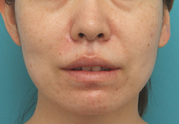 症例写真,分厚い上下の唇を手術で薄くした症例写真,After（6ヶ月後）,ba_usuku012_b02.jpg