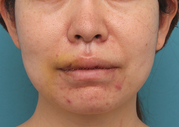 症例写真,分厚い上下の唇を手術で薄くした症例写真,5日後,口を閉じた状態,mainpic_usuku012e.jpg