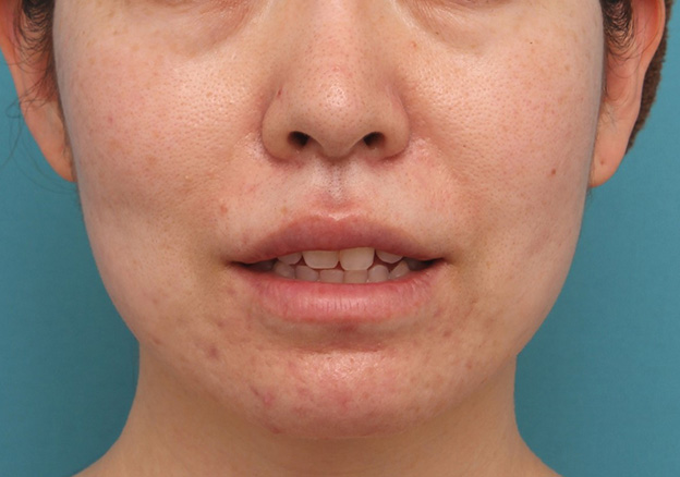 症例写真,分厚い上下の唇を手術で薄くした症例写真,2ヶ月後,口を開けた状態,mainpic_usuku012l.jpg