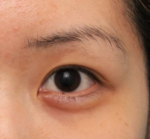ヒアルロン酸注射でやや大きめな涙袋を作った症例写真,After（8ヶ月後）,ba_namida015_a01.jpg