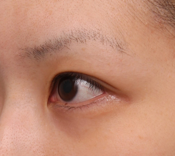 症例写真,ヒアルロン酸注射でやや大きめな涙袋を作った症例写真,Before,ba_namida015_b02.jpg
