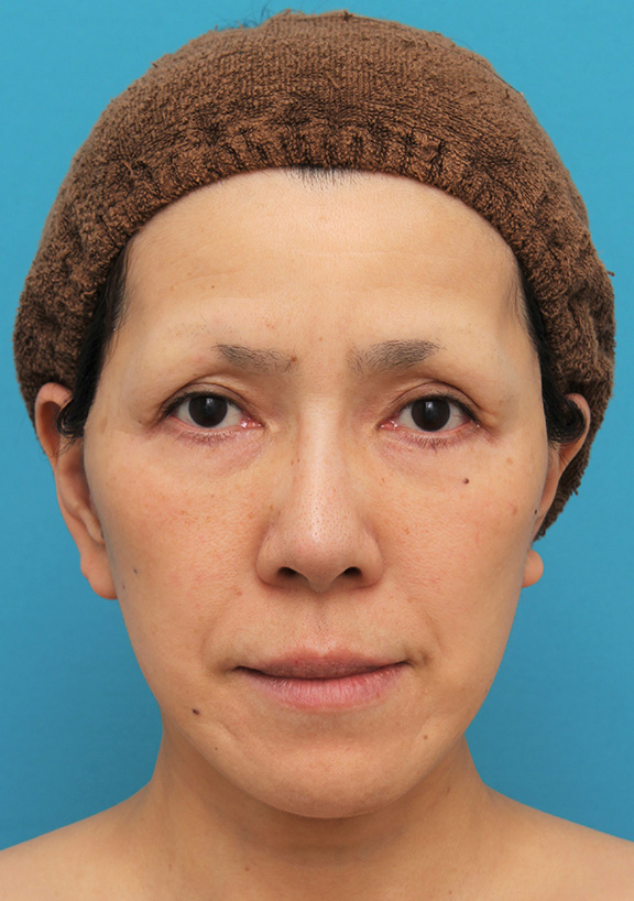 症例写真,フェイスリフトで頬、フェイスライン、顎下、首のたるみをリフトアップした症例写真,After（6ヶ月後）,ba_facelift004_b01.jpg