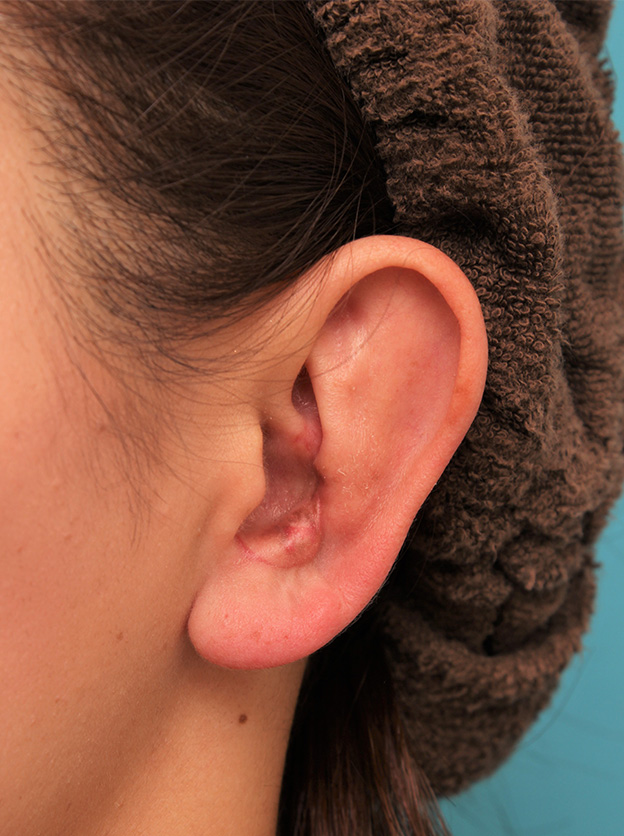 症例写真,柔道耳（レッスルイヤー、カリフラワー耳）の手術の症例写真,1ヶ月後,mainpic_judomimi001d.jpg