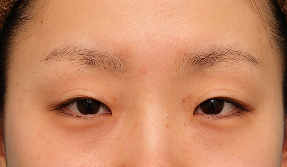 患者様の希望で幅広平行型二重を眼瞼下垂手術で作り、同時に目頭切開と目尻切開を行った症例写真,Before,ba_ganken039_b01.jpg
