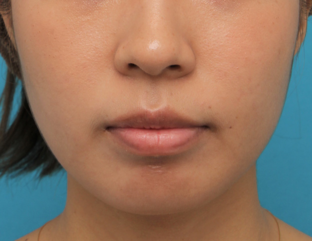 症例写真,ガミースマイルをボツリヌストキシン注射で改善させた20代女性の症例写真,1週間後,口を閉じた状態,mainpic_gammy_botox003e.jpg