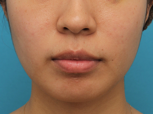 症例写真,ガミースマイルをボツリヌストキシン注射で改善させた20代女性の症例写真,1ヶ月後,口を閉じた状態,mainpic_gammy_botox003g.jpg