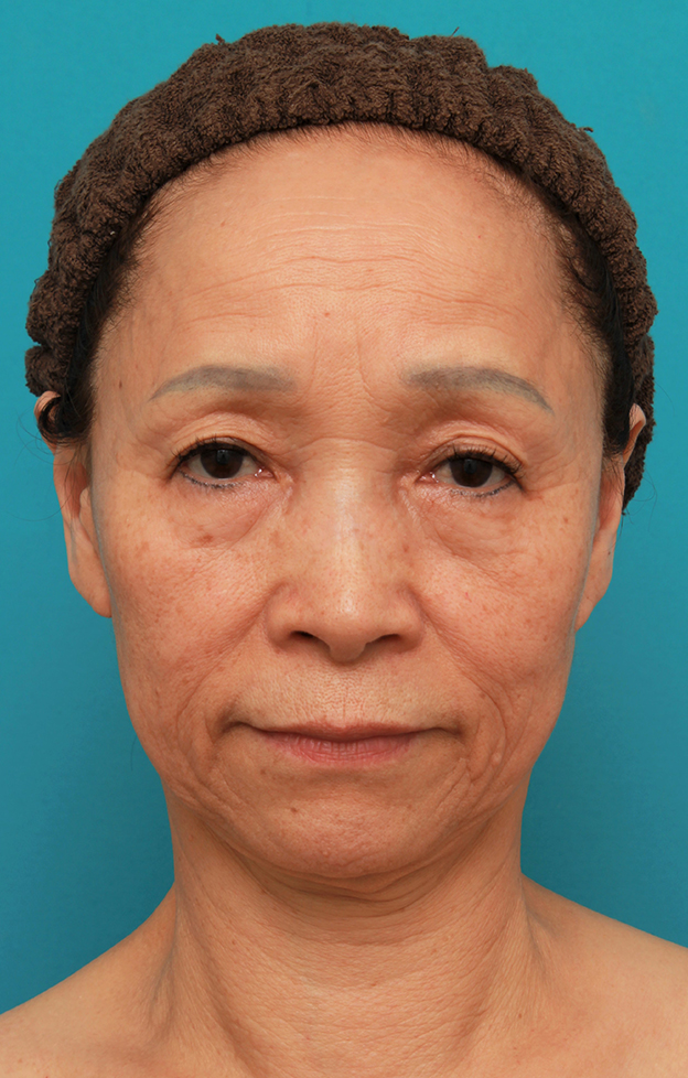 症例写真,フェイスリフトで頬、フェイスライン、首のたるみをリフトアップさせた70代女性の症例写真,手術前,mainpic_facelift005a.jpg