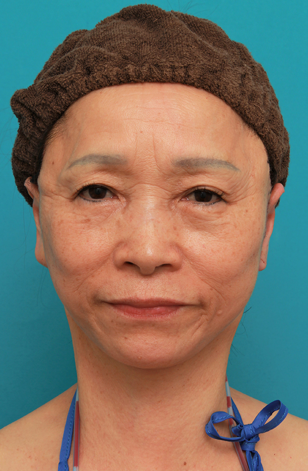 症例写真,フェイスリフトで頬、フェイスライン、首のたるみをリフトアップさせた70代女性の症例写真,手術直後,mainpic_facelift005b.jpg