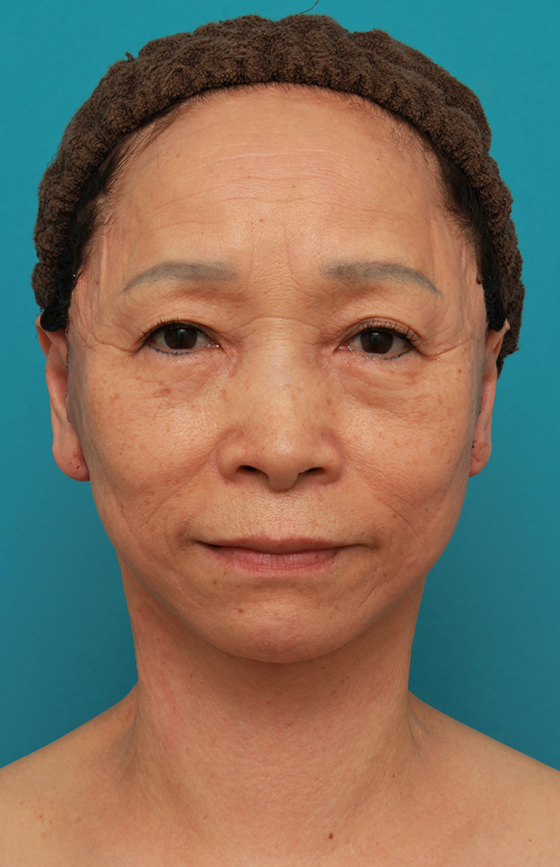 症例写真,フェイスリフトで頬、フェイスライン、首のたるみをリフトアップさせた70代女性の症例写真,手術翌日,mainpic_facelift005c.jpg