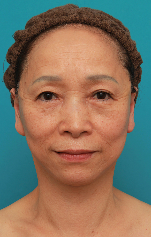 症例写真,フェイスリフトで頬、フェイスライン、首のたるみをリフトアップさせた70代女性の症例写真,1週間後,mainpic_facelift005d.jpg