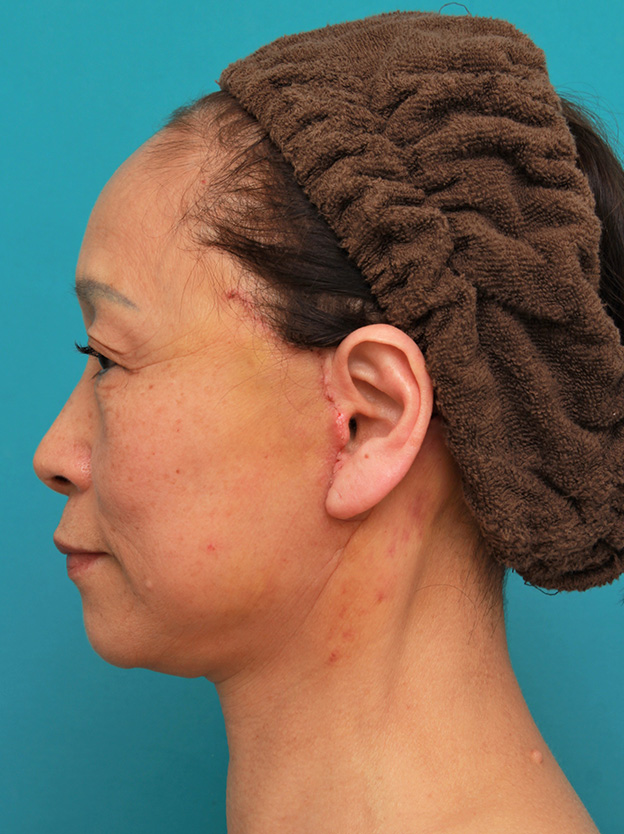 症例写真,フェイスリフトで頬、フェイスライン、首のたるみをリフトアップさせた70代女性の症例写真,1週間後,mainpic_facelift005i.jpg
