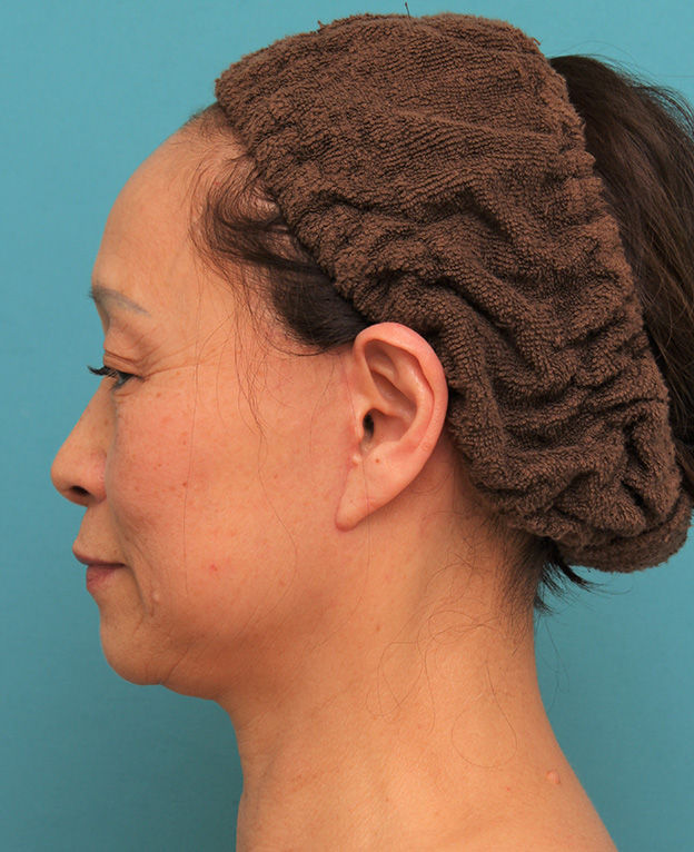 症例写真,フェイスリフトで頬、フェイスライン、首のたるみをリフトアップさせた70代女性の症例写真,6ヶ月後,mainpic_facelift005j.jpg
