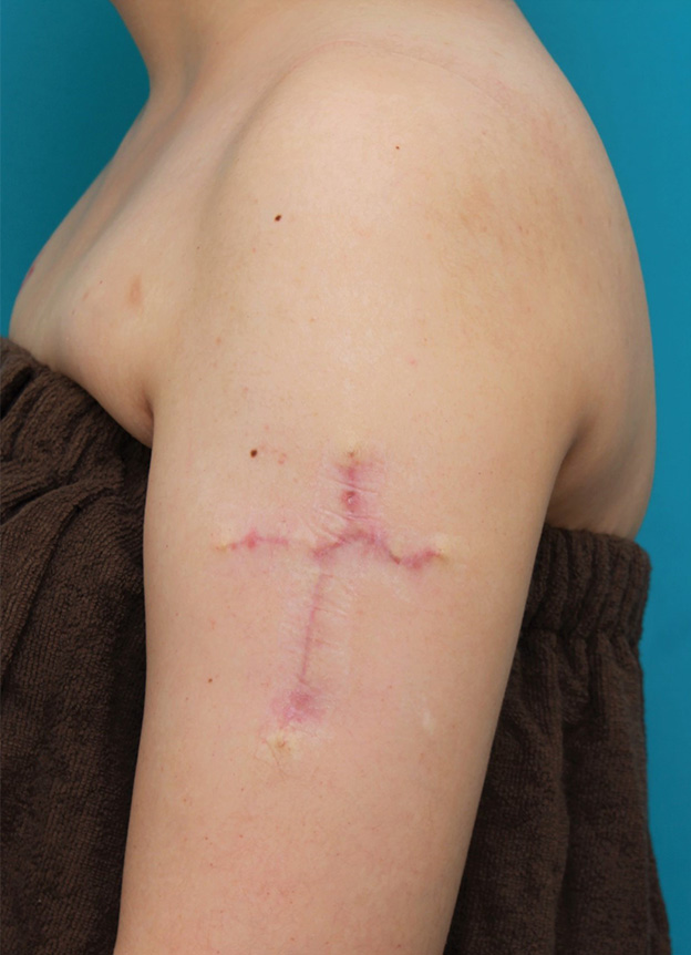 症例写真,肩に入っている十字架の入れ墨を1回で切除縫縮した20代女性の症例写真,3ヶ月後,mainpic_irezumi034e.jpg