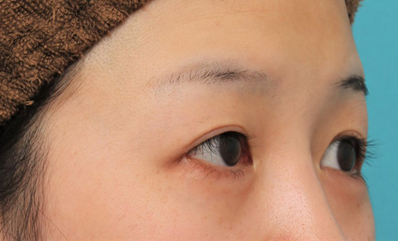 症例写真,目尻切開で目を外側に広げた20代女性の症例写真,After（6ヶ月後）,ba_mejiri022_b02.jpg
