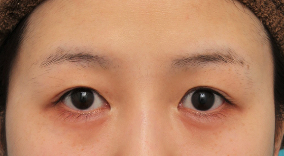 症例写真,目尻切開で目を外側に広げた20代女性の症例写真,Before,ba_mejiri022_b01.jpg