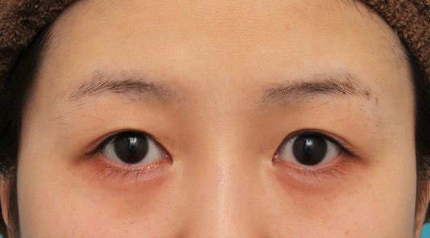 症例写真,目尻切開で目を外側に広げた20代女性の症例写真,手術前,mainpic_mejiri022a.jpg