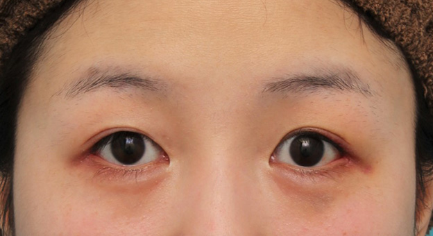 症例写真,目尻切開で目を外側に広げた20代女性の症例写真,6日後,mainpic_mejiri022c.jpg