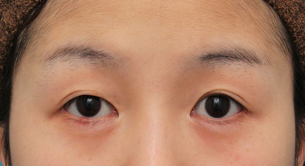 症例写真,目尻切開で目を外側に広げた20代女性の症例写真,3週間後,mainpic_mejiri022d.jpg