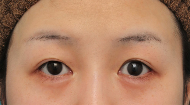症例写真,目尻切開で目を外側に広げた20代女性の症例写真,6ヶ月後,mainpic_mejiri022e.jpg