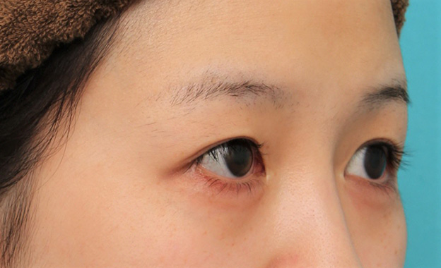 症例写真,目尻切開で目を外側に広げた20代女性の症例写真,手術前,mainpic_mejiri022f.jpg