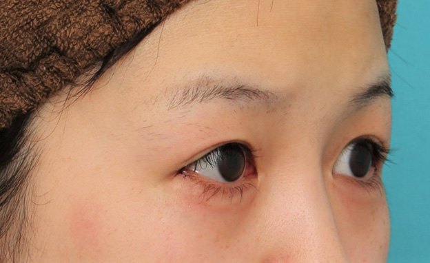 症例写真,目尻切開で目を外側に広げた20代女性の症例写真,手術直後,mainpic_mejiri022g.jpg