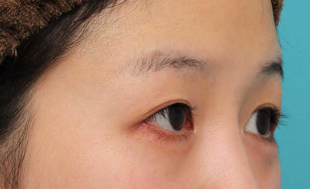 症例写真,目尻切開で目を外側に広げた20代女性の症例写真,6日後,mainpic_mejiri022h.jpg