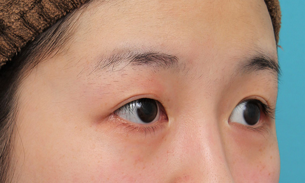 症例写真,目尻切開で目を外側に広げた20代女性の症例写真,3週間後,mainpic_mejiri022i.jpg