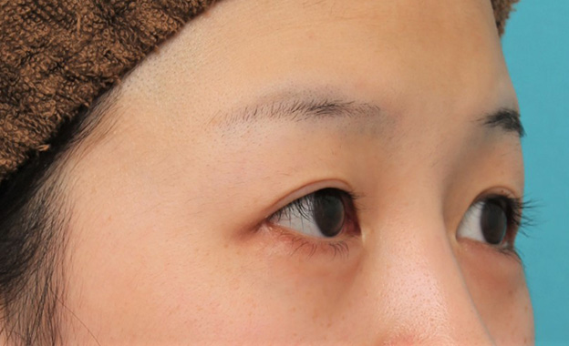 症例写真,目尻切開で目を外側に広げた20代女性の症例写真,6ヶ月後,mainpic_mejiri022j.jpg