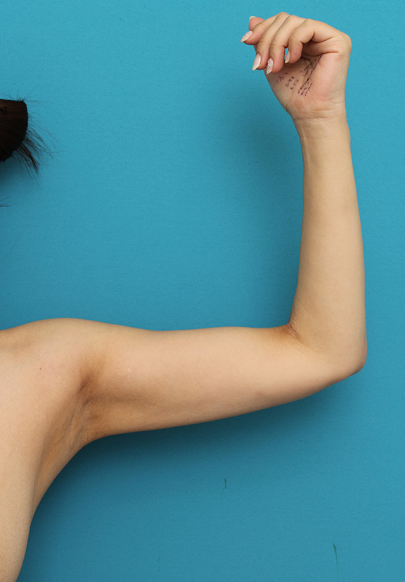 症例写真,40代女性の太い二の腕を脂肪吸引で細くした症例写真,After（6ヶ月後）,ba_shibokyuin041_b03.jpg