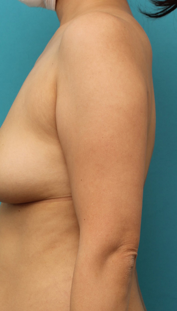 脂肪吸引,40代女性の太い二の腕を脂肪吸引で細くした症例写真,Before,ba_shibokyuin041_b01.jpg