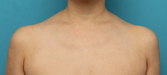 症例写真,美人肩ボツリヌストキシン注射で肩の筋肉（僧帽筋）を萎縮させスッキリした症例写真,Before,ba_beautiful_shoulder_botox004_b01.jpg