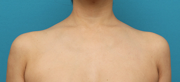 症例写真,美人肩ボツリヌストキシン注射で肩の筋肉（僧帽筋）を萎縮させスッキリした症例写真,2ヶ月後,mainpic_beautiful_shoulder_botox004d.jpg