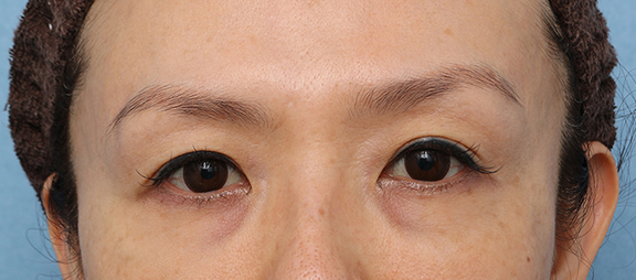 症例写真,サーマクールアイFLXの症例写真,After（1ヶ月後）,ba_thermacool_eye009_b01.jpg