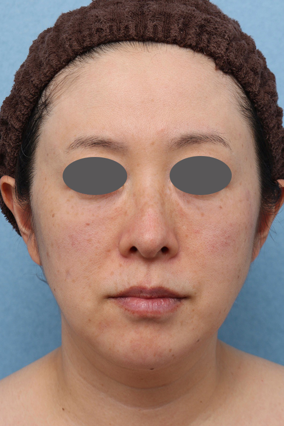 小顔専用脂肪溶解注射メソシェイプフェイス,ウルセラシステム,Vシェイプリフト（ヒアルロン酸注射）,リフトアップの症例写真,After（2ヶ月後）,ba_ulthera037_a01.jpg