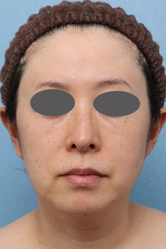 小顔専用脂肪溶解注射メソシェイプフェイス,ウルセラシステム,Vシェイプリフト（ヒアルロン酸注射）,リフトアップの症例写真,Before,ba_ulthera037_b01.jpg