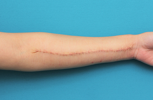 症例写真,リストカットの傷跡を2回に分けて切除縫合手術した症例写真,2回目手術後1ヶ月,mainpic_keisei018i.jpg