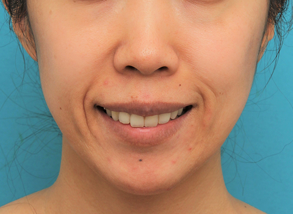 症例写真,ガミースマイルを手術で治した40代女性の症例写真,After（6ヶ月後）,ba_gammy006_b01.jpg