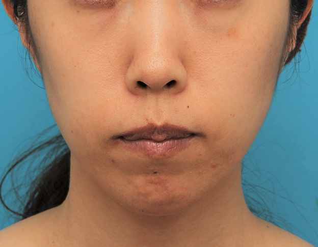 症例写真,ガミースマイルを手術で治した40代女性の症例写真,手術前,口を閉じた状態,mainpic_gammy006a.jpg