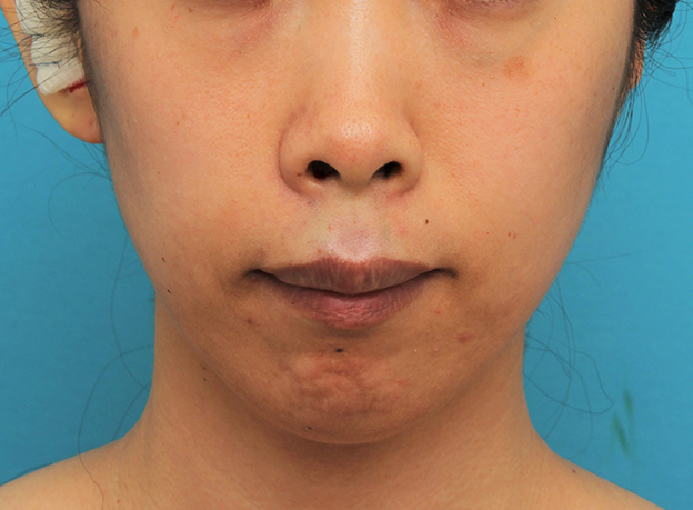 症例写真,ガミースマイルを手術で治した40代女性の症例写真,手術直後,口を閉じた状態,mainpic_gammy006c.jpg