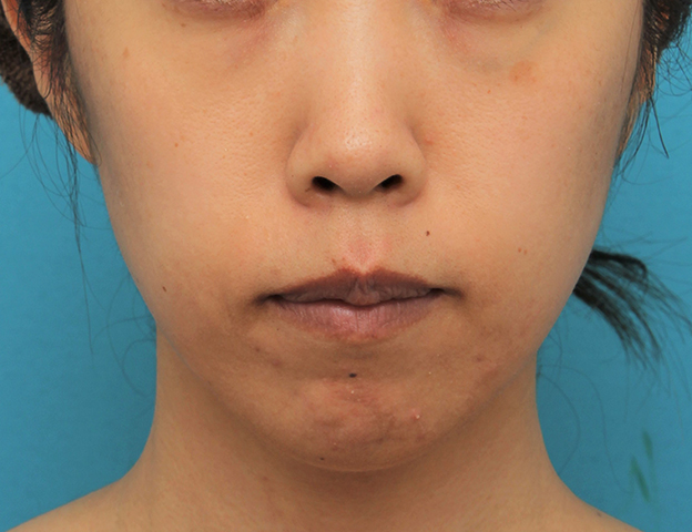 症例写真,ガミースマイルを手術で治した40代女性の症例写真,3週間後,口を閉じた状態,mainpic_gammy006g.jpg