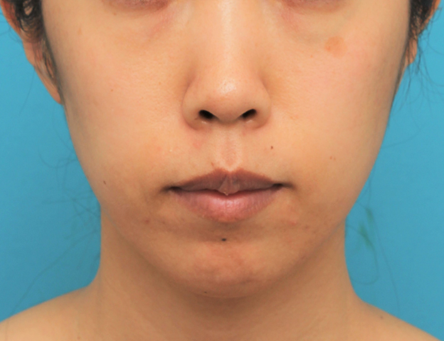 症例写真,ガミースマイルを手術で治した40代女性の症例写真,2ヶ月後,口を閉じた状態,mainpic_gammy006i.jpg