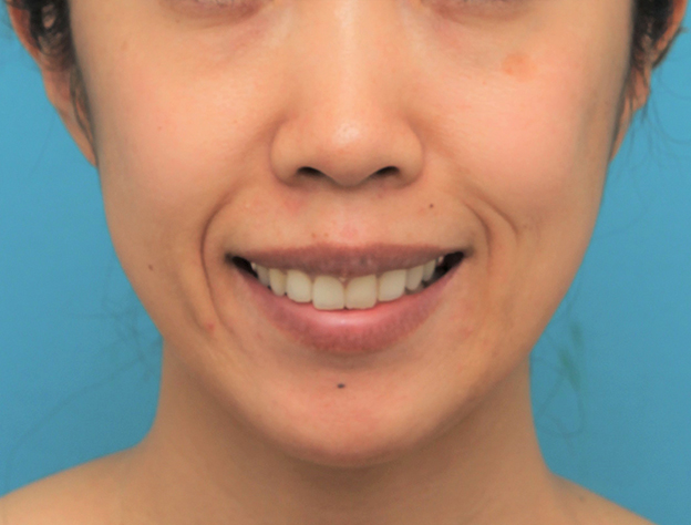 症例写真,ガミースマイルを手術で治した40代女性の症例写真,2ヶ月後,口を開けた状態,mainpic_gammy006j.jpg