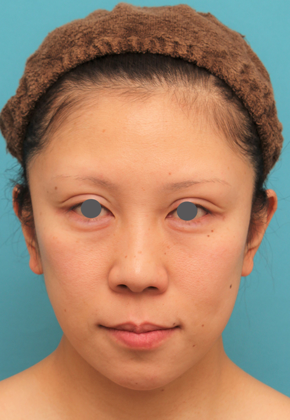 ミディアムフェイスリフトの症例 顔の下半分のたるみが目立つ40代女性,After（2ヶ月後）,ba_mediumlift013_a01.jpg