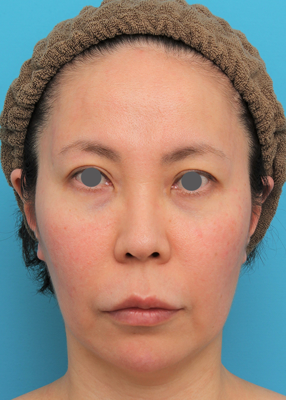 ミディアムフェイスリフト＋人中短縮＋鼻柱への耳介軟骨移植を行った症例写真,Before,ba_mediumlift014_b01.jpg