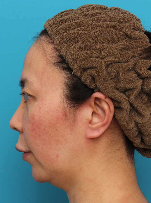 耳介軟骨移植（鼻先を出す）,ミディアムフェイスリフト＋人中短縮＋鼻柱への耳介軟骨移植を行った症例写真,Before,ba_mediumlift014_b03.jpg