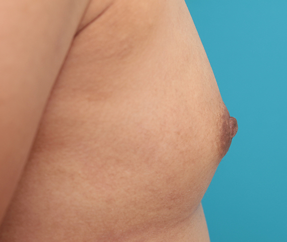 症例写真,30代後半女性の乳頭縮小手術症例写真,After（6ヶ月後）,ba_nyuto021_b03.jpg