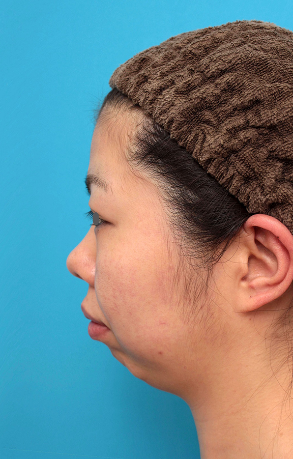 耳介軟骨移植（鼻先を出す）,鼻尖形成、耳介軟骨移植、顎プロテーゼ入れの症例写真,Before,ba_bisen029_b02.jpg