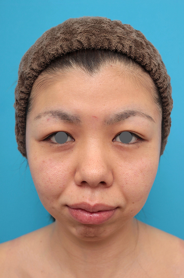 症例写真,鼻尖形成、耳介軟骨移植、顎プロテーゼ入れの症例写真,施術前,mainpic_bisen029a.jpg