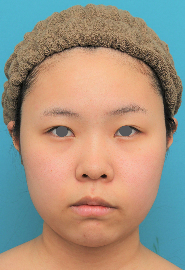 症例写真,顔（頬～フェイスライン～顎下）の脂肪吸引をした20代女性の症例写真,手術前,mainpic_shibo006a.jpg